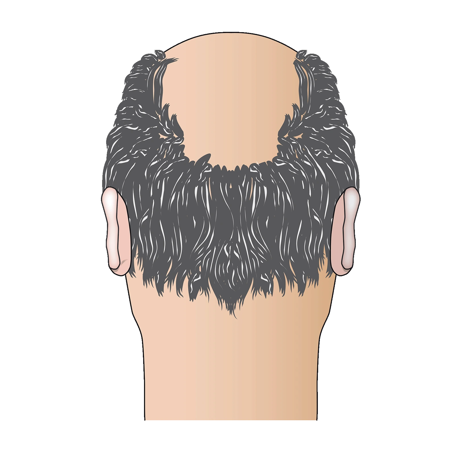Schritt 1 und Ausgangslage vor der Haartransplantation: Grafik eines männlichen Hinterkopfes, wo auf dem Kopf kahle Stellen (Glatze) sind