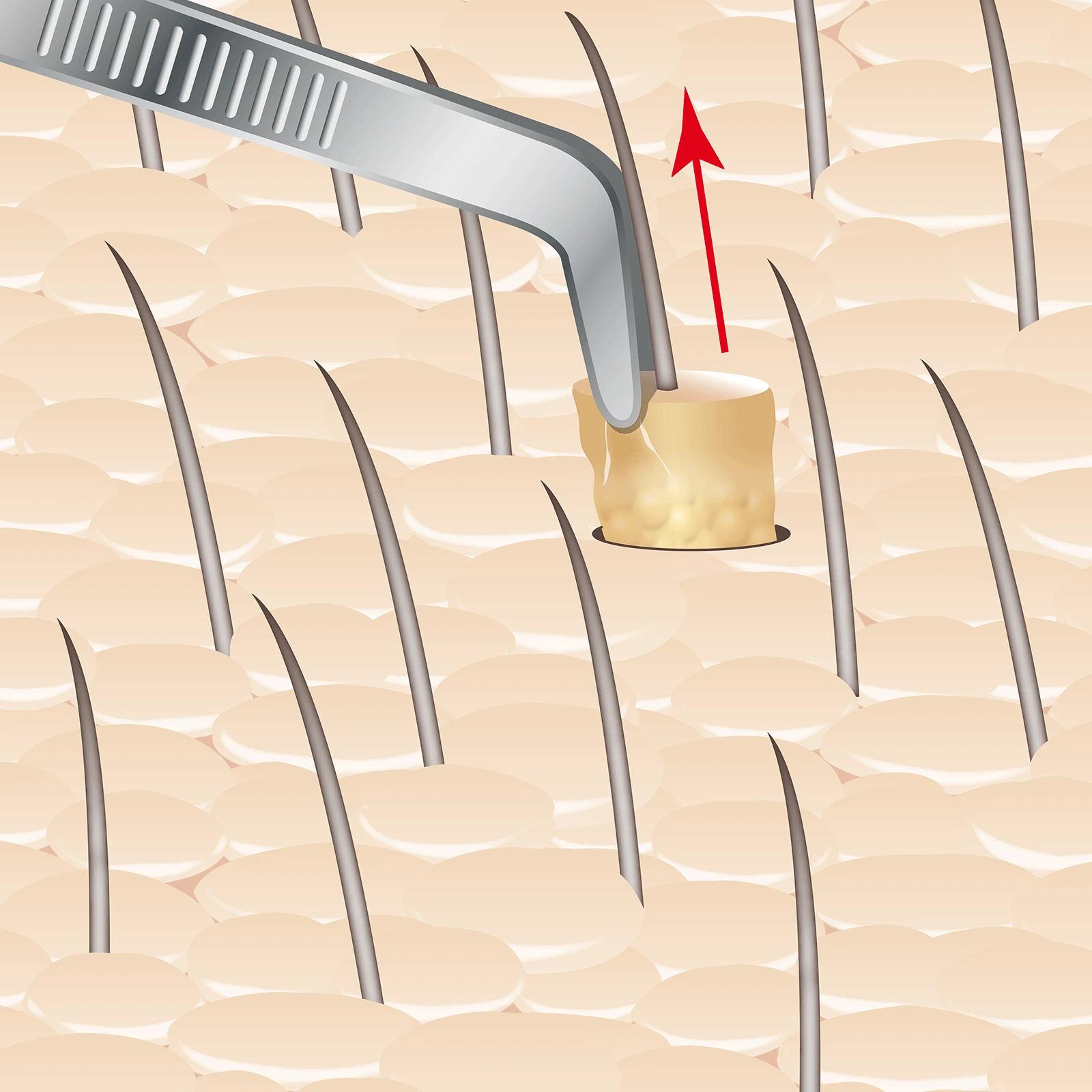 Schritt 4 der Haartransplantation: Grafik, wie mit einer speziellen gebogenen Pinzette ein Graft vom Spendengebiet entnommen wird