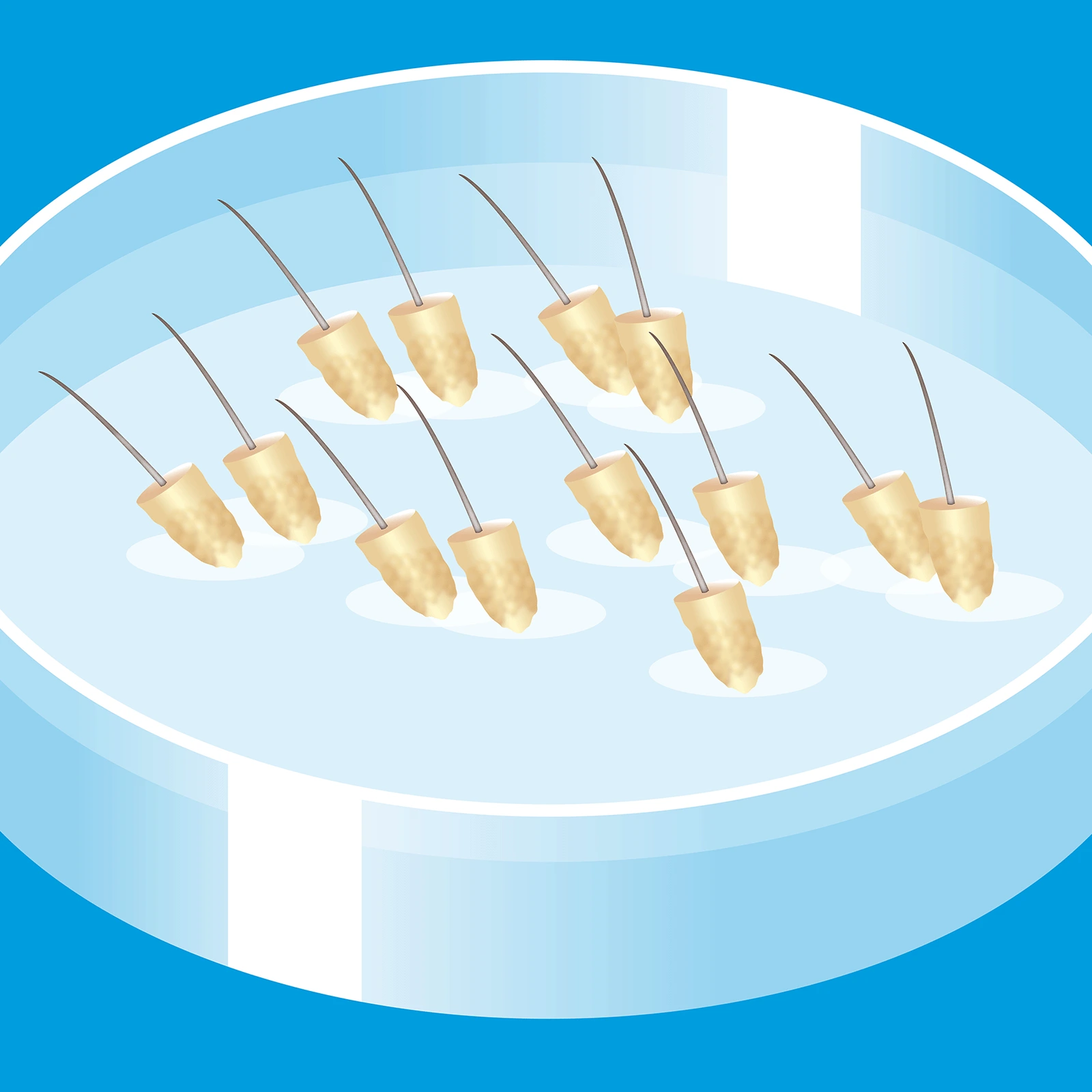 Schritt 5 der Haartransplantation: Grafik einer Petrischale mit Nährlösungm worin die extrahierten Grafts, die Haare, eingelagert sind, bevor sie implantiert werden
