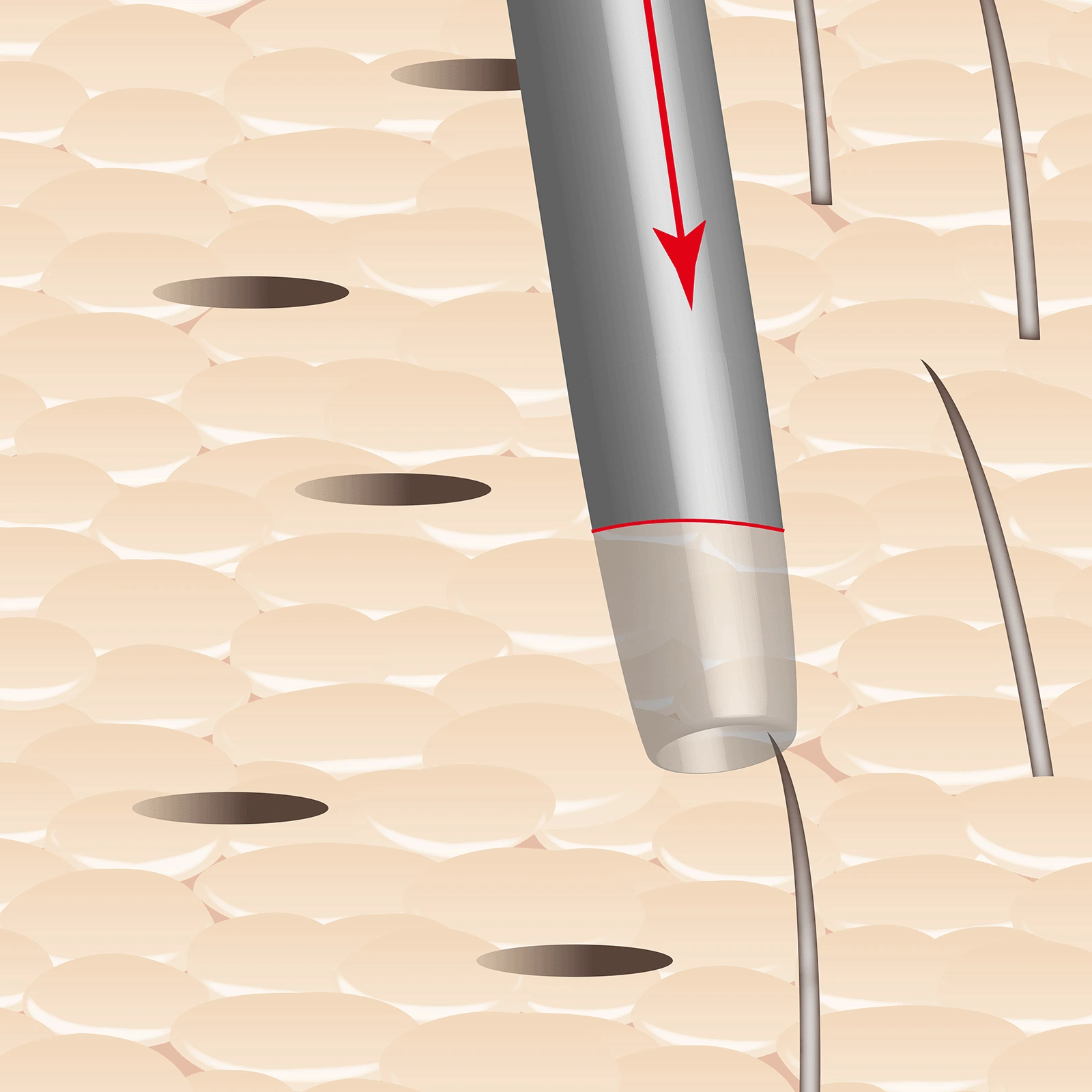 Schritt 6: Grafische Darstellung, wie mit einer Hohlnadel das Zielgebiet der FUE-Haartransplantation vorbereitet wird