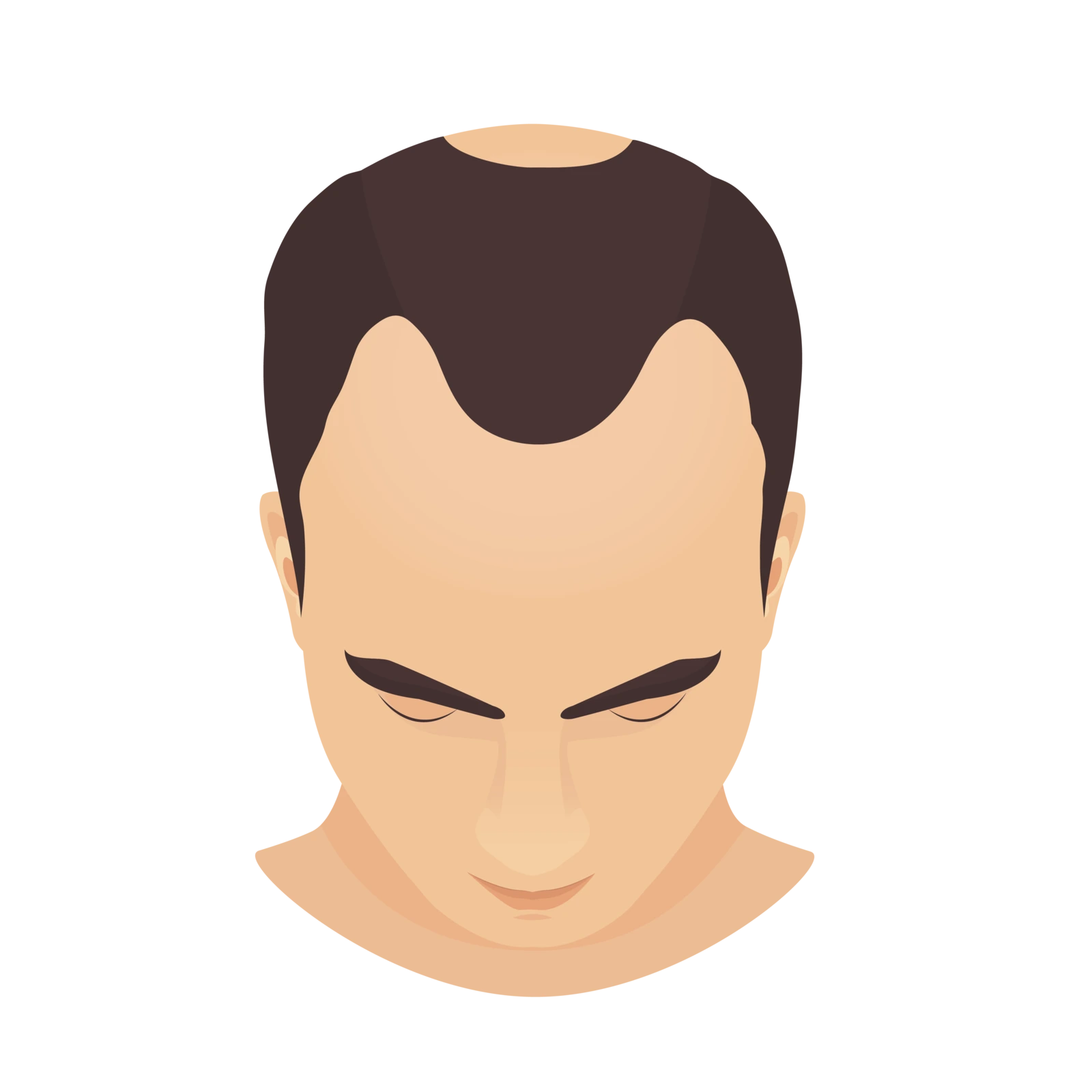 Grafik eines leicht nach unten guckenden männlichen Kopfes. Der Haarsansatz ist weit oben , er hat Geheimratsecken und eine Tonsur (Glatze)
