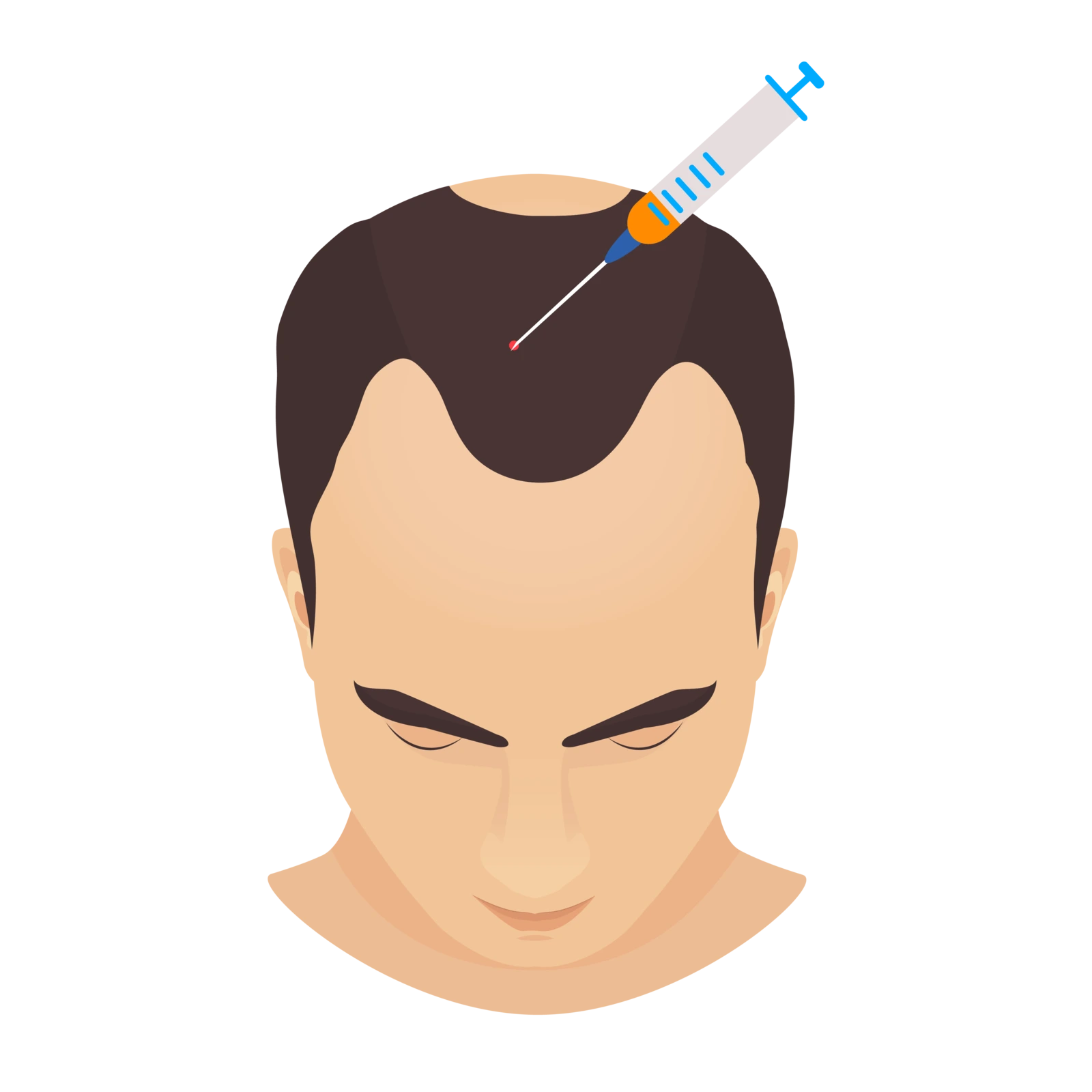 Grafik eines männlichen Kopfes, dem eine Spritze mit fibrinhaltigem Plasma (I-PRF) in den Stirnbereich injiziert wird